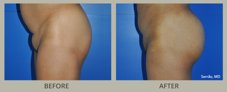 Mons Pubis Liposuction Before and After Pictures Orlando, FL