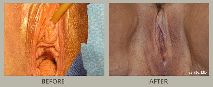 Perineoplasty Before and After Pictures Orlando, FL