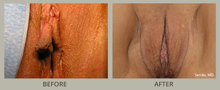 Perineoplasty Before and After Pictures Orlando, FL